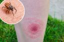 What is Lyme disease and what symptoms should you look out for?